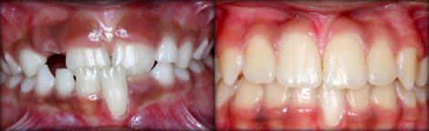 Gingival Recession due to Cross Bite