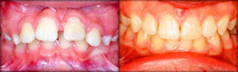 Severe Overbite & Large Gap