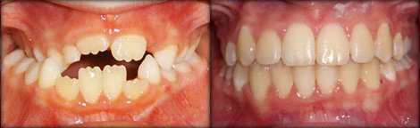 Posterior Cross Bite & Open Bite