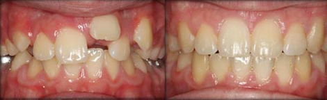 Out of position Incisor