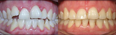 Severe Enamel Wear dur to poor Bite