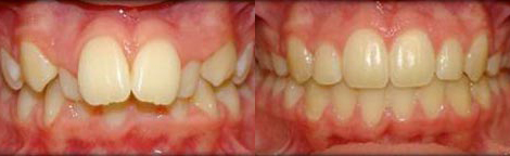 Severe Overbite / Overjet