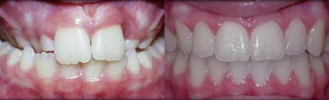 Severe Constriction & Narrow Palate