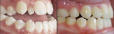 Severe Open Bite & Peg Incisor